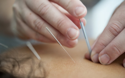 Acupuncture vs Chiropractor: Which Do You Need?